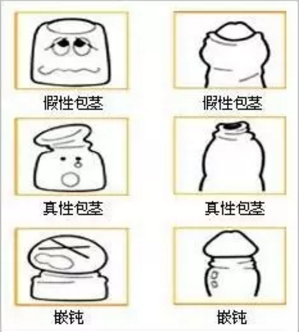 宝鸡所有的包皮过长，都需要进行包皮手术吗