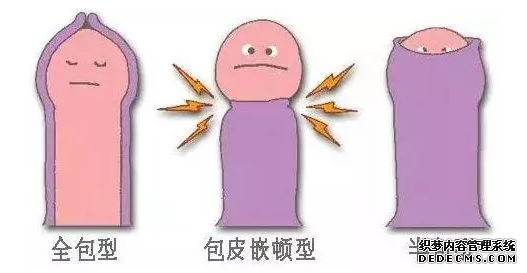 宝鸡自己属于包皮包茎哪类型呢？赶紧看看吧！