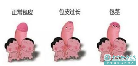 赤峰宁城县啥样的包皮要进行手术呢